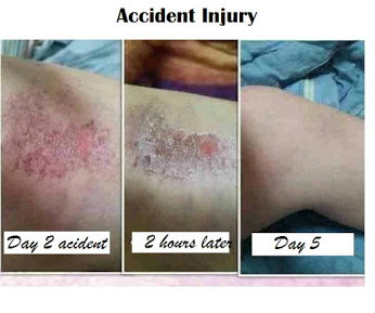 acupuncture for pain